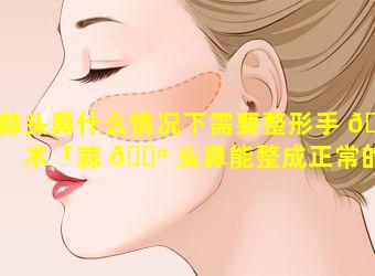 蒜头鼻什么情况下需要整形手 🐝 术「蒜 🌺 头鼻能整成正常的鼻子吗」